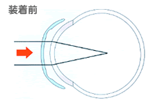 水晶体の切開