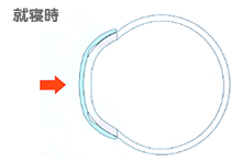 水晶体の中身の乳化吸引