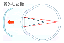 眼内レンズの挿入